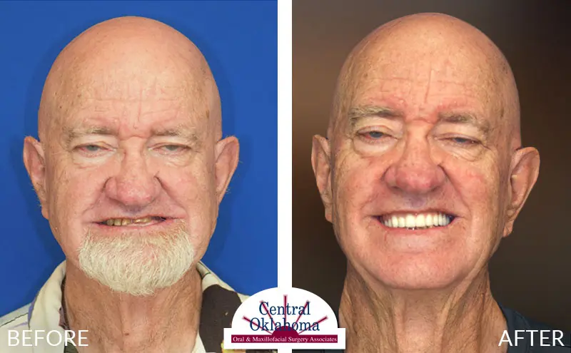 dental implants before and after | Oral Surgery Tulsa | Dr. Richard Miller | Central Oklahoma Oral & Maxillofacial Surgery Associates