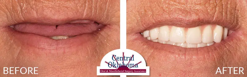 dental implants before and after | Oral Surgery Tulsa | Dr. Richard Miller | Central Oklahoma Oral & Maxillofacial Surgery Associates