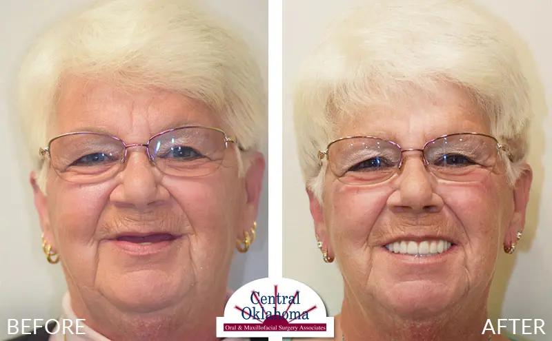 dental implants before and after | Oral Surgery Tulsa | Dr. Richard Miller | Central Oklahoma Oral & Maxillofacial Surgery Associates