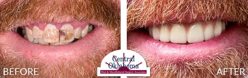 dental implants before and after | Oral Surgery Tulsa | Dr. Richard Miller | Central Oklahoma Oral & Maxillofacial Surgery Associates