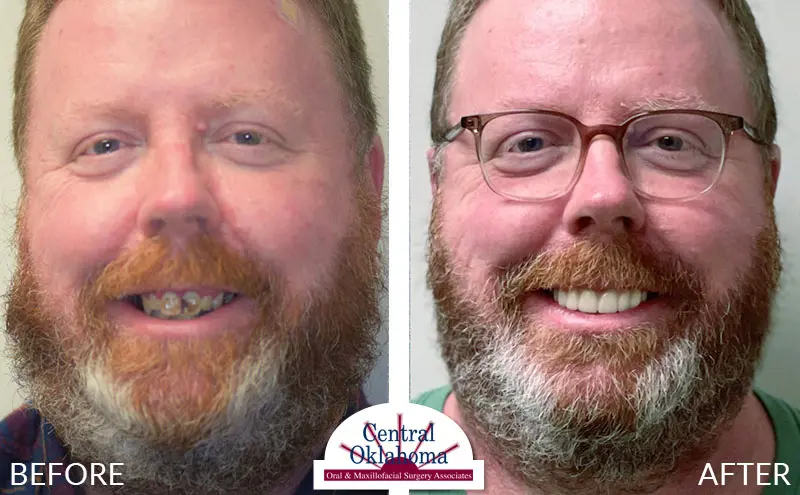 dental implants before and after | Oral Surgery Tulsa | Dr. Richard Miller | Central Oklahoma Oral & Maxillofacial Surgery Associates