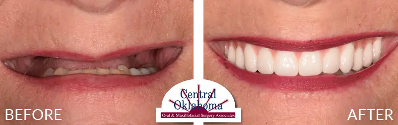 dental implants before and after | Oral Surgery Tulsa | Dr. Richard Miller | Central Oklahoma Oral & Maxillofacial Surgery Associates