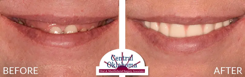 Oral Surgery before and after | Oral Surgery Oklahoma City | Dr. Richard Miller | Central Oklahoma Oral & Maxillofacial Surgery Associates