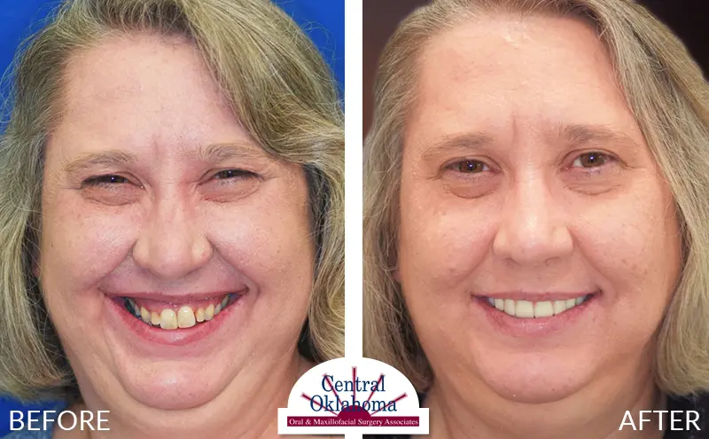 Oral Surgery before and after | Oral Surgery Oklahoma City | Dr. Richard Miller | Central Oklahoma Oral & Maxillofacial Surgery Associates