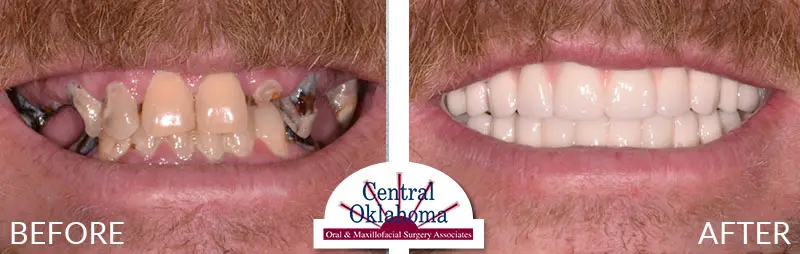 Oral Surgery before and after | Oral Surgery Oklahoma City | Dr. Richard Miller | Central Oklahoma Oral & Maxillofacial Surgery Associates