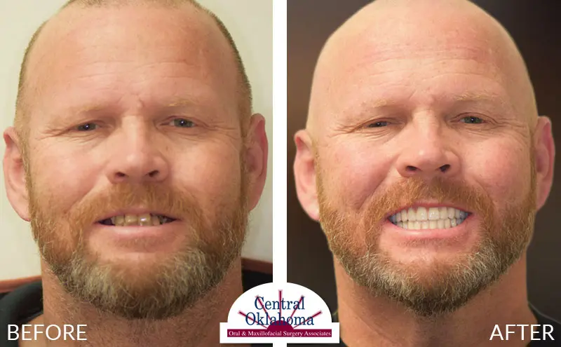 Oral Surgery before and after | Oral Surgery Oklahoma City | Dr. Richard Miller | Central Oklahoma Oral & Maxillofacial Surgery Associates