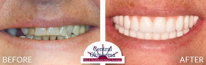 Oral Surgery before and after | Oral Surgery Oklahoma City | Dr. Richard Miller | Central Oklahoma Oral & Maxillofacial Surgery Associates