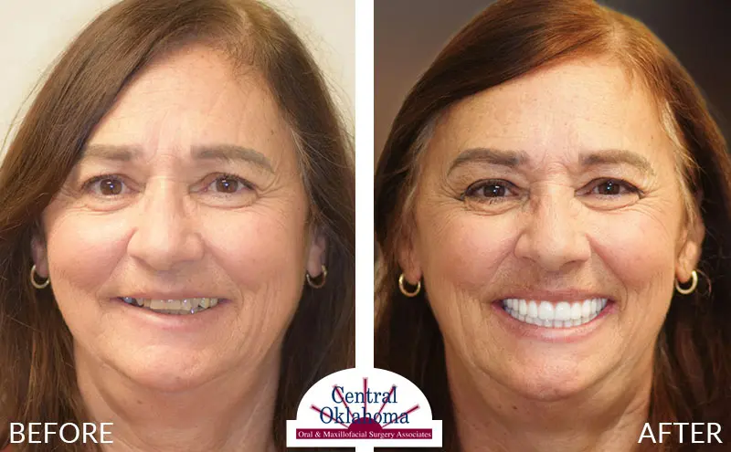 Oral Surgery before and after | Oral Surgery Oklahoma City | Dr. Richard Miller | Central Oklahoma Oral & Maxillofacial Surgery Associates