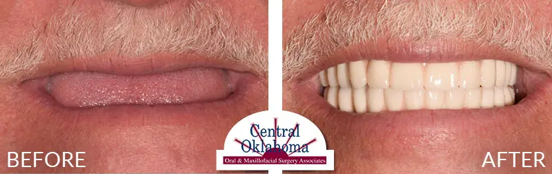 Oral Surgery before and after | Oral Surgery Oklahoma City | Dr. Richard Miller | Central Oklahoma Oral & Maxillofacial Surgery Associates