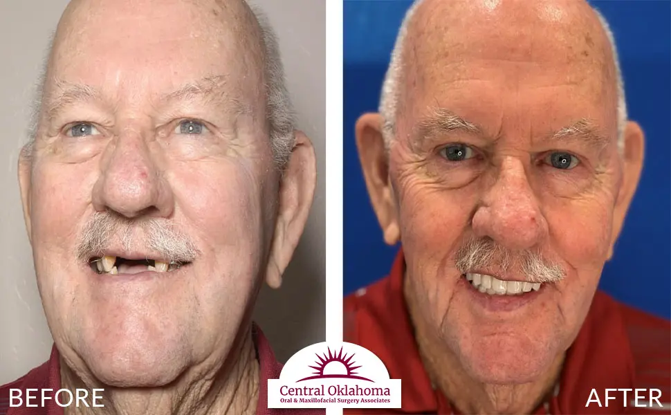 Oral Surgery before and after | Oral Surgery Oklahoma City | Dr. Richard Miller | Central Oklahoma Oral & Maxillofacial Surgery Associates