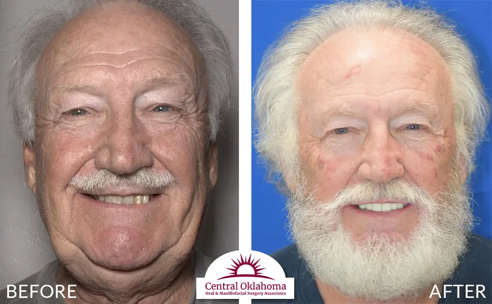 Oral Surgery before and after | Oral Surgery Oklahoma City | Dr. Richard Miller | Central Oklahoma Oral & Maxillofacial Surgery Associates