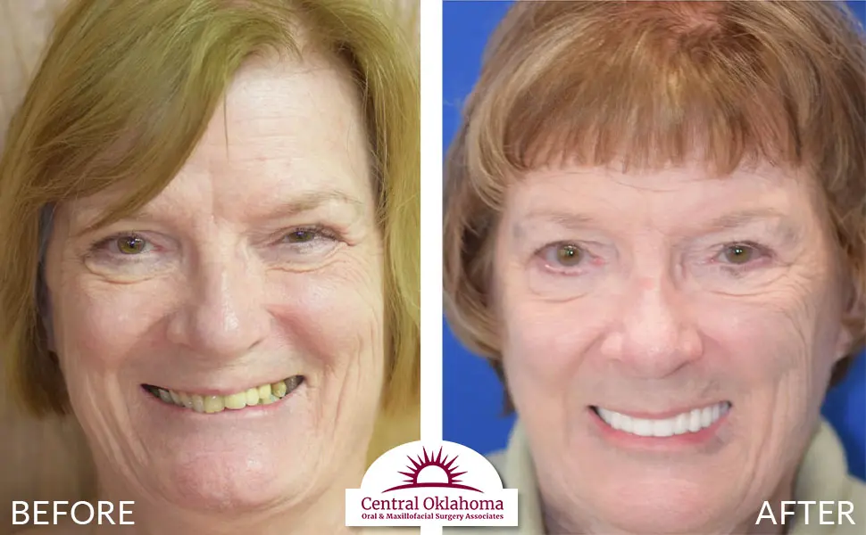 Oral Surgery before and after | Oral Surgery Oklahoma City | Dr. Richard Miller | Central Oklahoma Oral & Maxillofacial Surgery Associates
