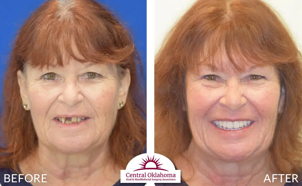 Oral Surgery before and after | Oral Surgery Oklahoma City | Dr. Richard Miller | Central Oklahoma Oral & Maxillofacial Surgery Associates