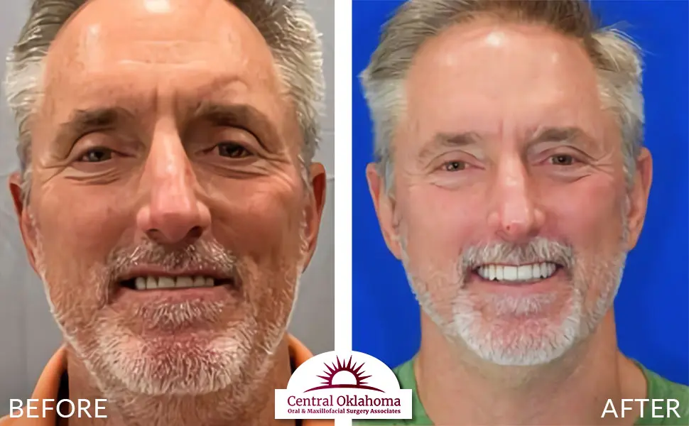 Oral Surgery before and after | Oral Surgery Oklahoma City | Dr. Richard Miller | Central Oklahoma Oral & Maxillofacial Surgery Associates