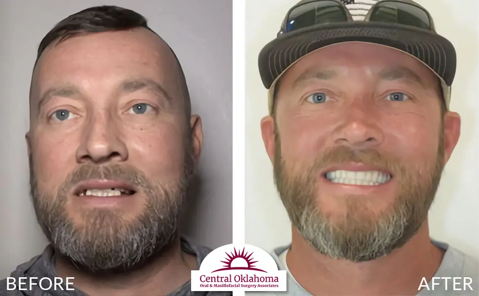 Oral Surgery before and after | Oral Surgery Oklahoma City | Dr. Richard Miller | Central Oklahoma Oral & Maxillofacial Surgery Associates