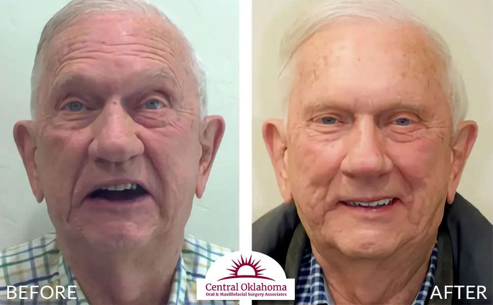 Oral Surgery before and after | Oral Surgery Oklahoma City | Dr. Richard Miller | Central Oklahoma Oral & Maxillofacial Surgery Associates