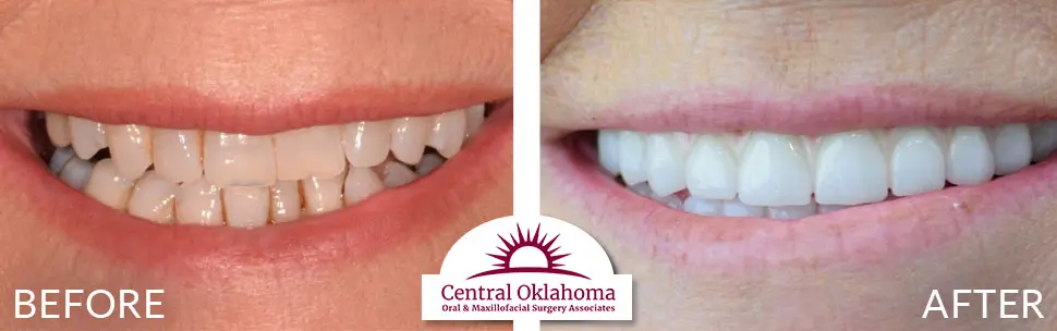 Oral Surgery before and after | Oral Surgery Oklahoma City | Dr. Richard Miller | Central Oklahoma Oral & Maxillofacial Surgery Associates