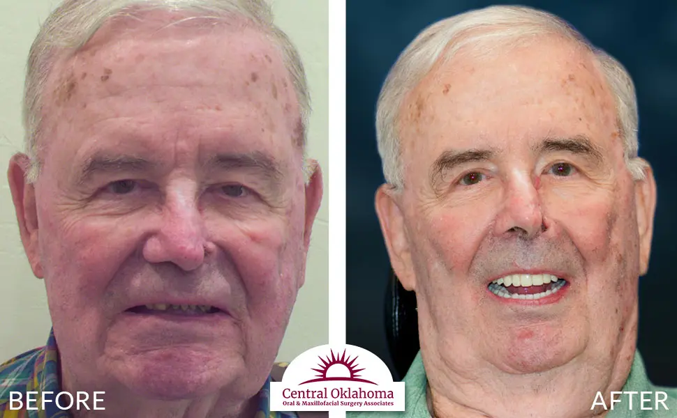 Oral Surgery before and after | Oral Surgery Oklahoma City | Dr. Richard Miller | Central Oklahoma Oral & Maxillofacial Surgery Associates