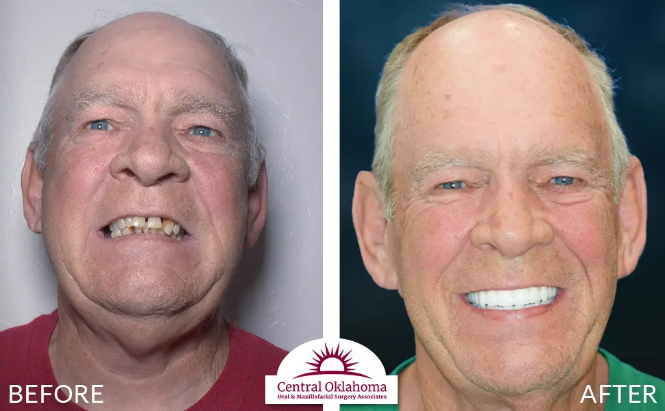 Oral Surgery before and after | Oral Surgery Oklahoma City | Dr. Richard Miller | Central Oklahoma Oral & Maxillofacial Surgery Associates