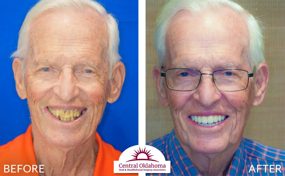 Oral Surgery before and after | Oral Surgery Oklahoma City | Dr. Richard Miller | Central Oklahoma Oral & Maxillofacial Surgery Associates