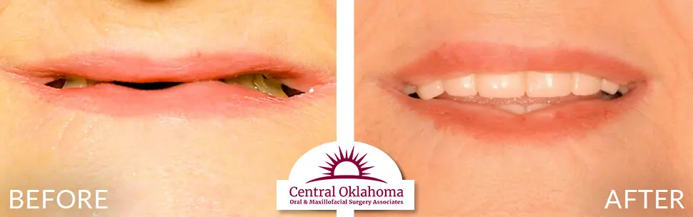 Oral Surgery before and after | Oral Surgery Oklahoma City | Dr. Richard Miller | Central Oklahoma Oral & Maxillofacial Surgery Associates