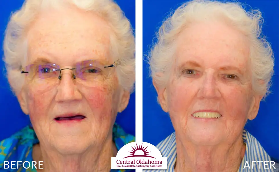 Oral Surgery before and after | Oral Surgery Oklahoma City | Dr. Richard Miller | Central Oklahoma Oral & Maxillofacial Surgery Associates