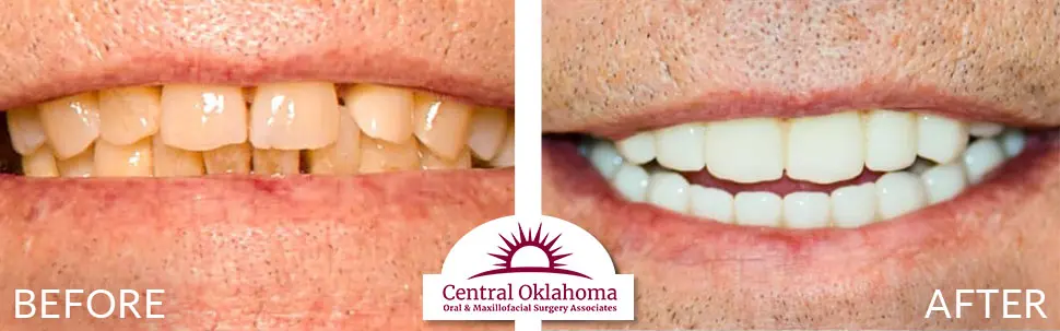 Oral Surgery before and after | Oral Surgery Oklahoma City | Dr. Richard Miller | Central Oklahoma Oral & Maxillofacial Surgery Associates
