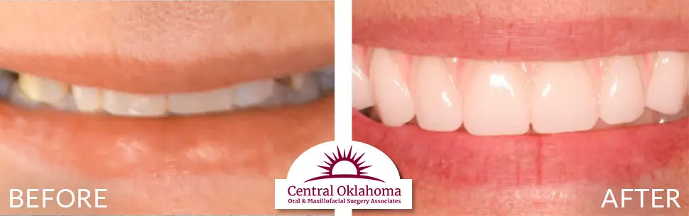 Oral Surgery before and after | Oral Surgery Oklahoma City | Dr. Richard Miller | Central Oklahoma Oral & Maxillofacial Surgery Associates