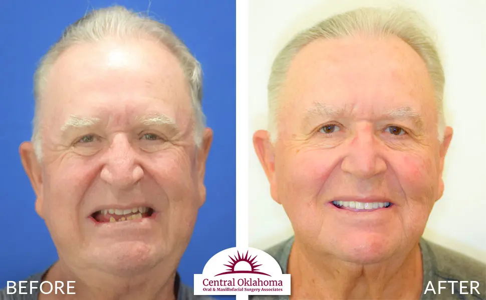 Oral Surgery before and after | Oral Surgery Oklahoma City | Dr. Richard Miller | Central Oklahoma Oral & Maxillofacial Surgery Associates