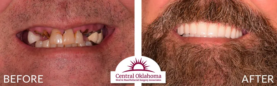 Oral Surgery before and after | Oral Surgery Oklahoma City | Dr. Richard Miller | Central Oklahoma Oral & Maxillofacial Surgery Associates