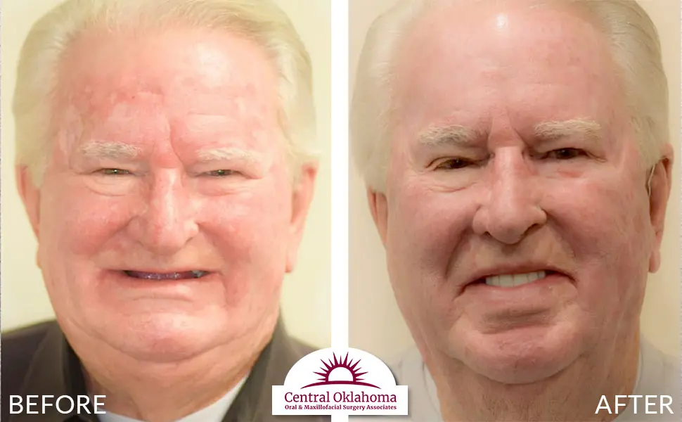 Oral Surgery before and after | Oral Surgery Oklahoma City | Dr. Richard Miller | Central Oklahoma Oral & Maxillofacial Surgery Associates