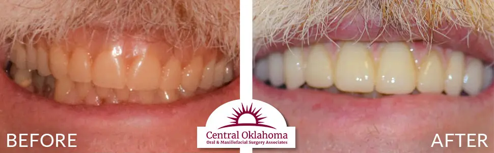Oral Surgery before and after | Oral Surgery Oklahoma City | Dr. Richard Miller | Central Oklahoma Oral & Maxillofacial Surgery Associates