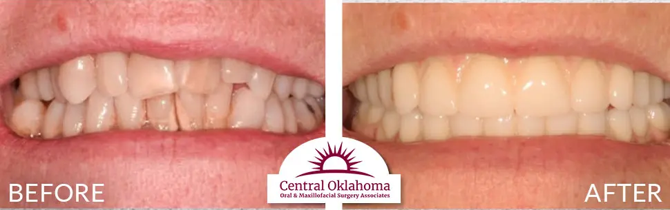 Oral Surgery before and after | Oral Surgery Oklahoma City | Dr. Richard Miller | Central Oklahoma Oral & Maxillofacial Surgery Associates