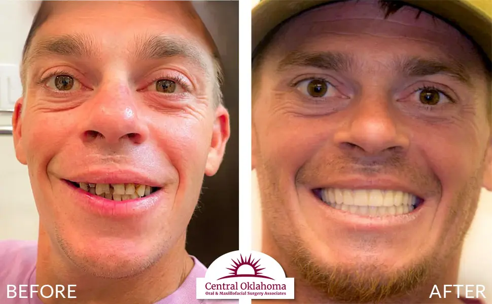 Oral Surgery before and after | Oral Surgery Oklahoma City | Dr. Richard Miller | Central Oklahoma Oral & Maxillofacial Surgery Associates