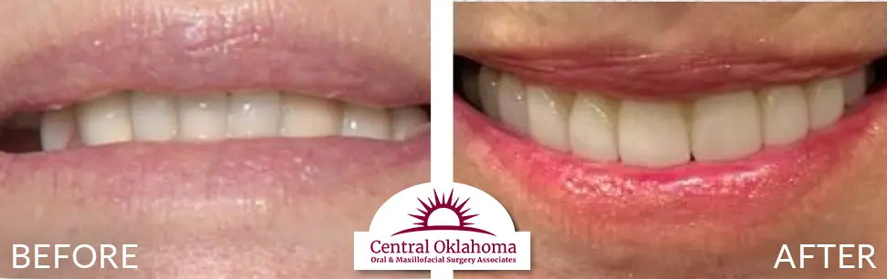 Oral Surgery before and after | Oral Surgery Oklahoma City | Dr. Richard Miller | Central Oklahoma Oral & Maxillofacial Surgery Associates