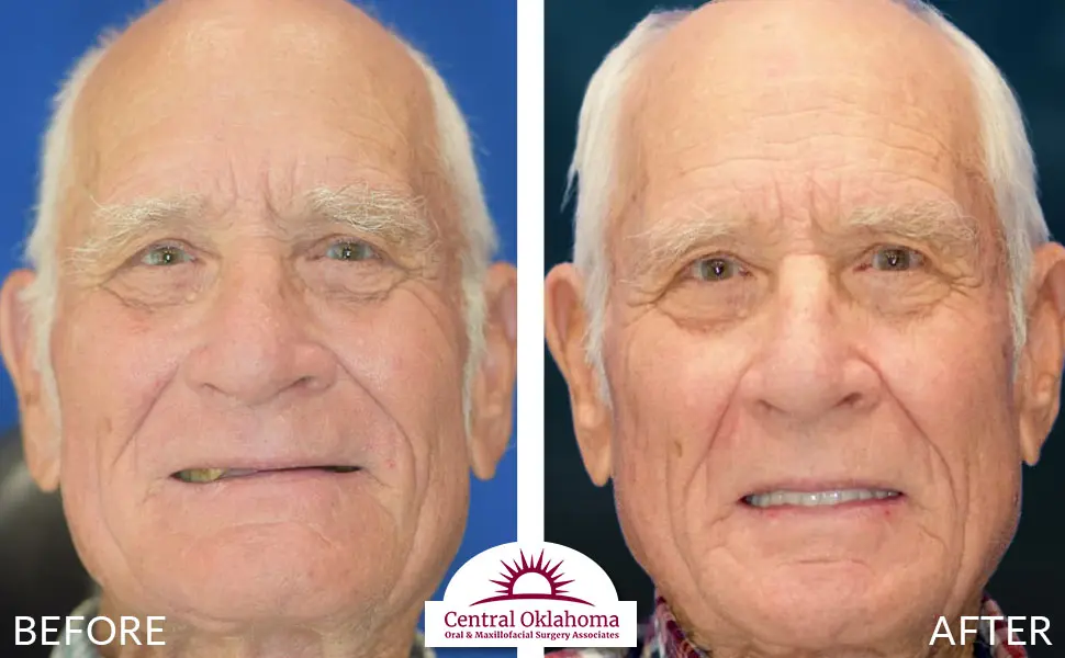 Oral Surgery before and after | Oral Surgery Oklahoma City | Dr. Richard Miller | Central Oklahoma Oral & Maxillofacial Surgery Associates