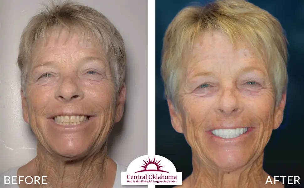 Oral Surgery before and after | Oral Surgery Oklahoma City | Dr. Richard Miller | Central Oklahoma Oral & Maxillofacial Surgery Associates