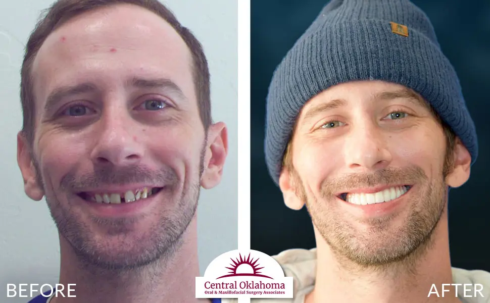 Oral Surgery before and after | Oral Surgery Oklahoma City | Dr. Richard Miller | Central Oklahoma Oral & Maxillofacial Surgery Associates