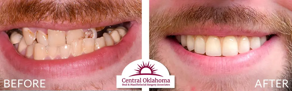 Oral Surgery before and after | Oral Surgery Oklahoma City | Dr. Richard Miller | Central Oklahoma Oral & Maxillofacial Surgery Associates