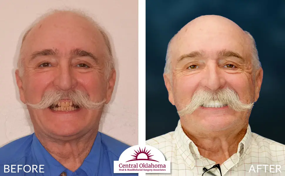 Oral Surgery before and after | Oral Surgery Oklahoma City | Dr. Richard Miller | Central Oklahoma Oral & Maxillofacial Surgery Associates