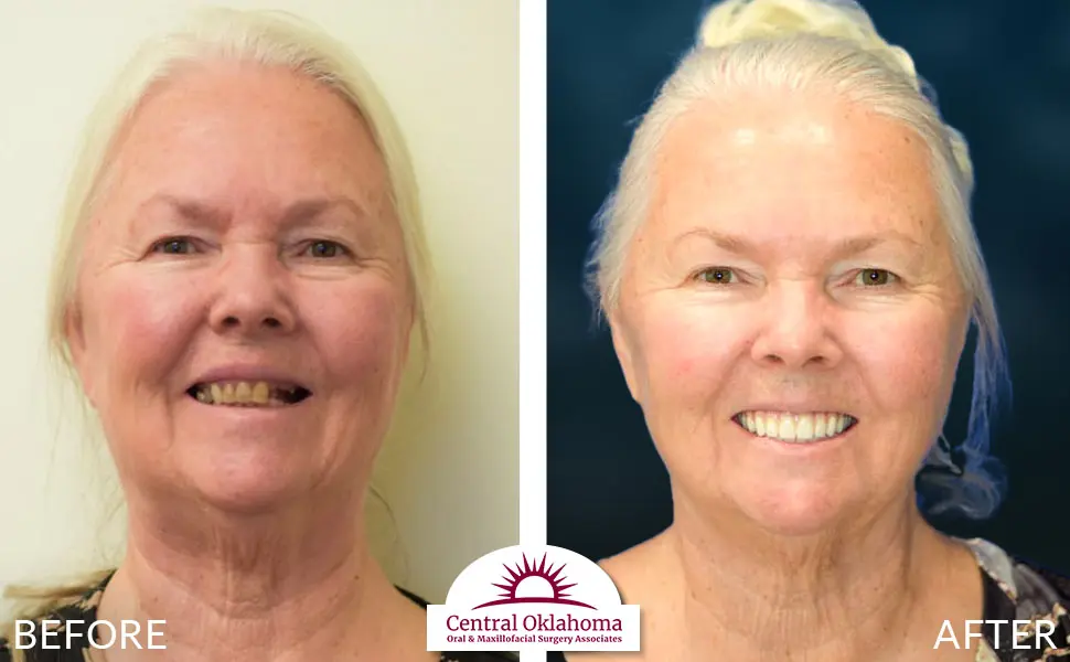 Oral Surgery before and after | Oral Surgery Oklahoma City | Dr. Richard Miller | Central Oklahoma Oral & Maxillofacial Surgery Associates