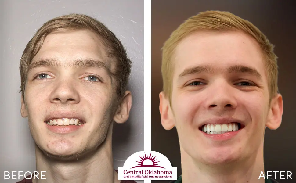 Oral Surgery before and after | Oral Surgery Oklahoma City | Dr. Richard Miller | Central Oklahoma Oral & Maxillofacial Surgery Associates