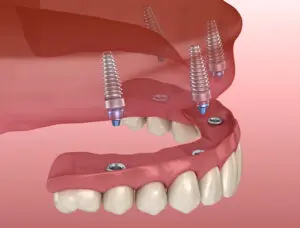 Maxillary prosthesis with gum All on 4 system supported by implants. Medically accurate 3D illustration of human teeth and dentures
