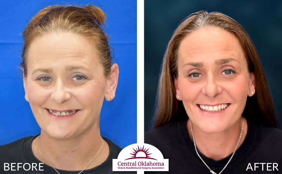 All on 4 implants | Oral Surgery Tulsa | Dr. Richard Miller | Central Oklahoma Oral & Maxillofacial Surgery Associates