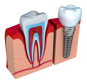 dental implants Stillwater