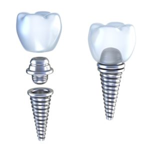 dental implants North Oklahoma