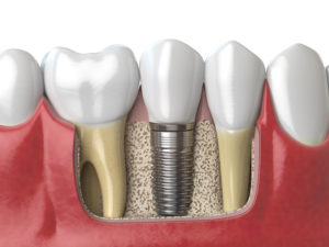 dental implants Stillwater