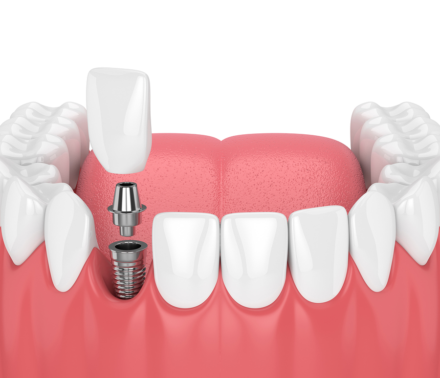 dental implants North Oklahoma