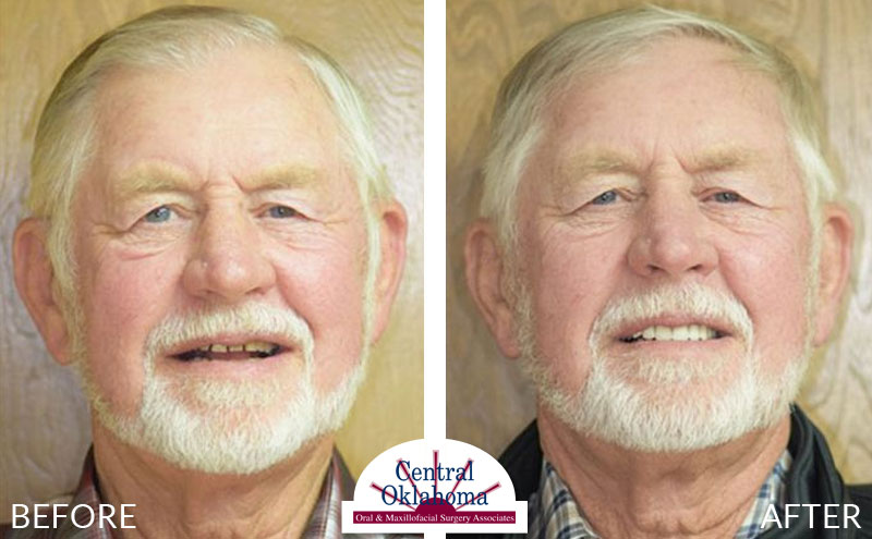 All-on-4 before and after | Oral Surgery OKC | Dr. Richard Miller | Central Oklahoma Oral & Maxillofacial Surgery Associates
