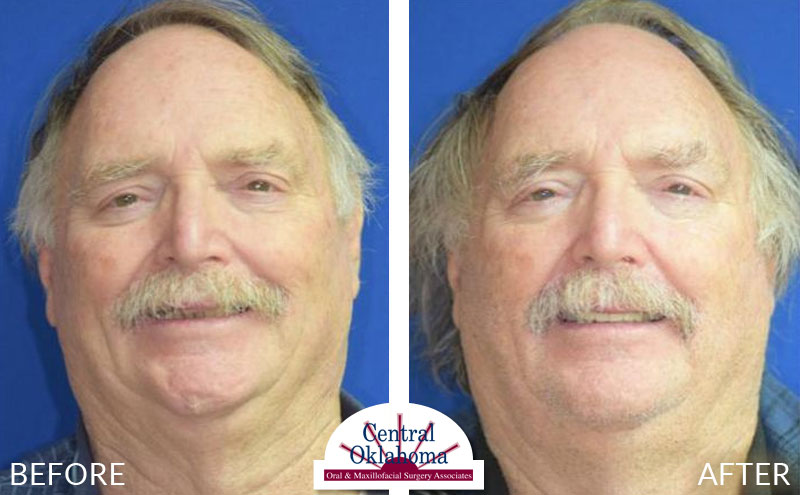 All-on-4 before and after | Oral Surgery Oklahoma City | Dr. Richard Miller | Central Oklahoma Oral & Maxillofacial Surgery Associates